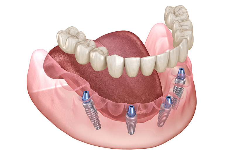 Full-Arch Implant Restorations in Apex