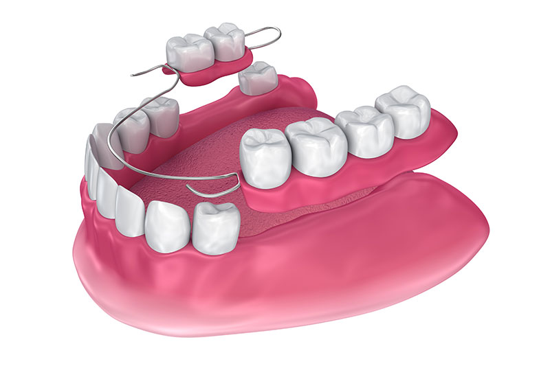 Removable Partial Dentures in Apex